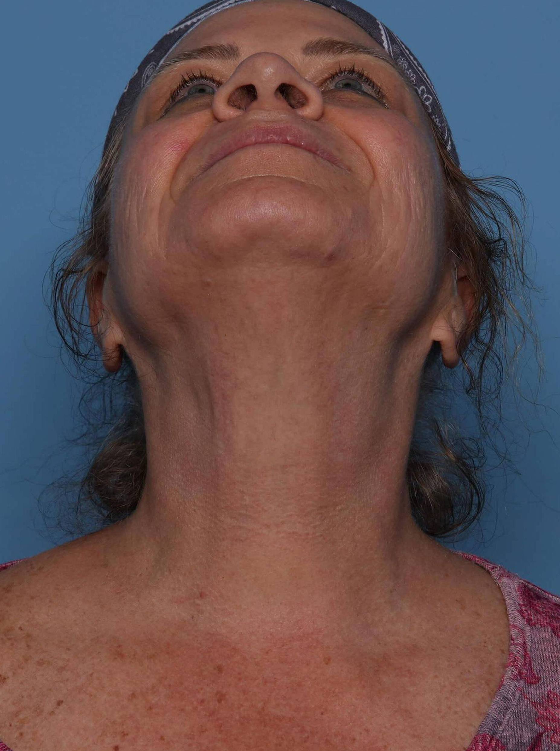 Top Front View After thumbnail
