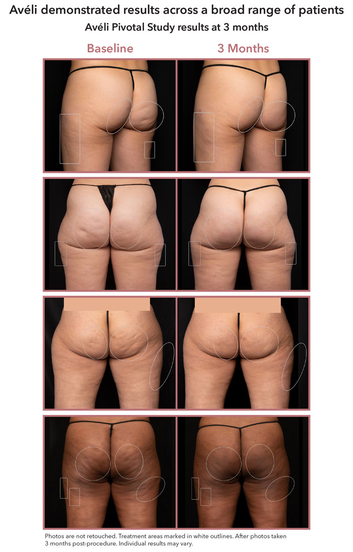 Aveli results