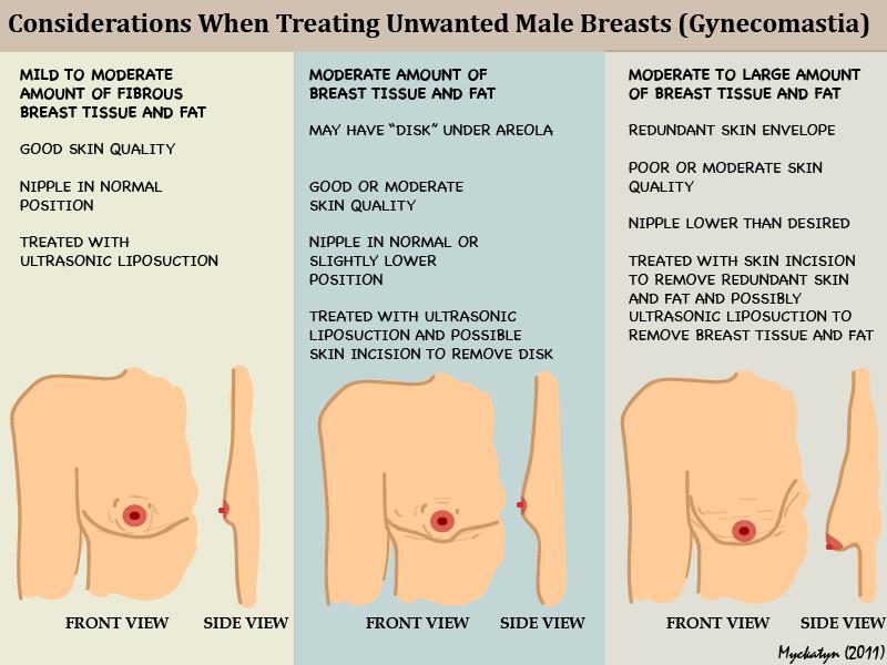 Factors to consider when treating gynecomastia Factors to consider when treating gynecomastia