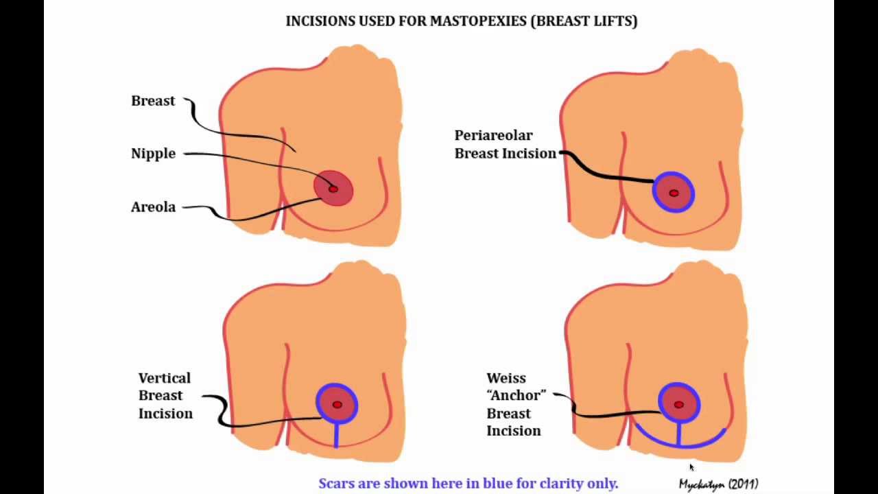 West County Plastic Surgeons Seminar: Breast Lift
