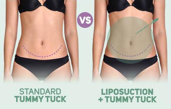 Tummy Tuck Illustration