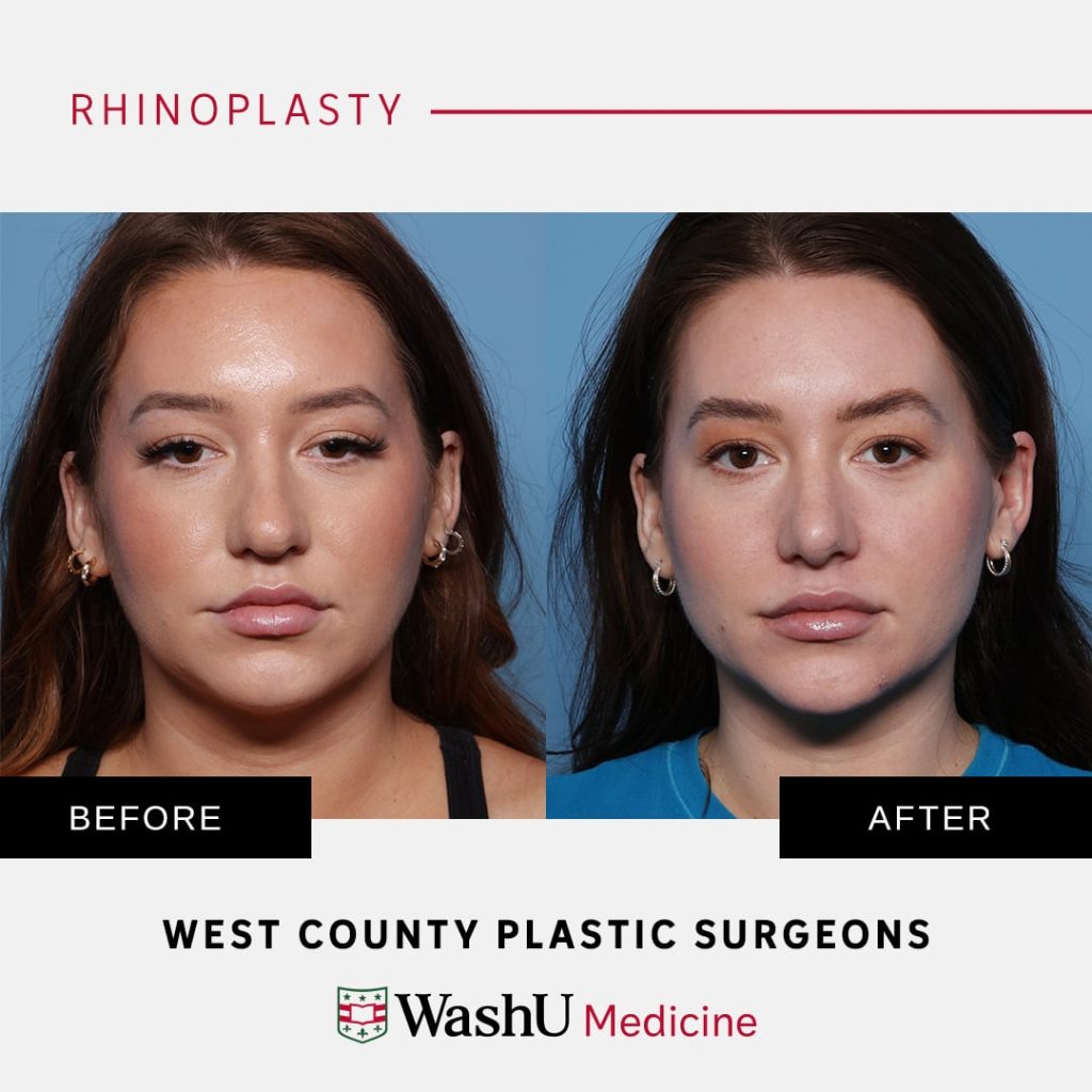 Before & after image of a rhinoplasty procedure at WCPS.